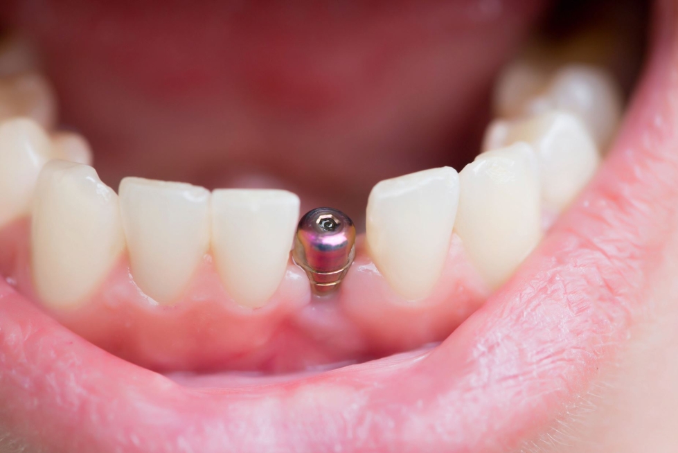 Hammasimplantti muodostuu keinojuuresta ja siihen liitettävästä hammasosasta. Hammasosaa kutsutaan proteettiseksi osuudeksi. Kela ei korvaa proteettisia toimenpiteitä paitsi rintamaveteraaneilla ja miinanraivaajilla.