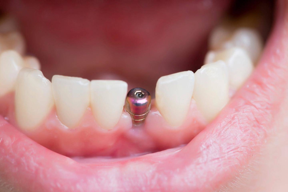 Hammasimplantti muodostuu keinojuuresta ja siihen liitettävästä hammasosasta.
