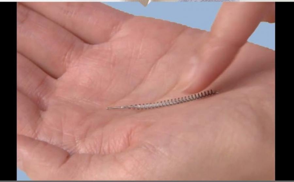 Munatorviin asetettavia Essure-implantteja esitellään http://www.essure.com -sivustolla. Leike videosta.